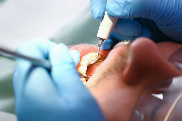 Best Emergency Tooth Extraction in Romulus, MI